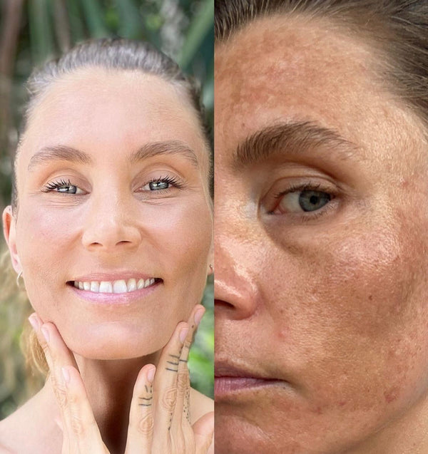 Treating Melasma Naturally: Q & A with Sophie Partik (and why holi (c) works)